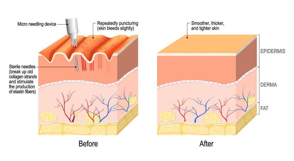 skn-aesthetics-microneedling